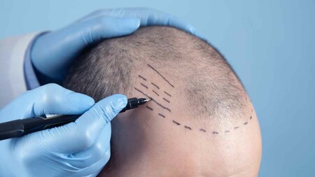 What is hair transplantation